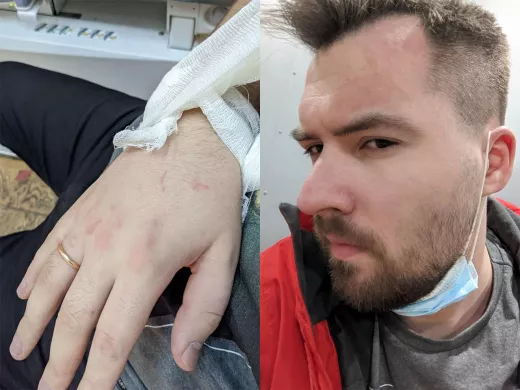 Le détenu Maxim Andreenkov blessé aux ligaments de l’articulation du coude droit. Selon lui, lors de l’arrestation, ses bras ont été tordus avec violence, il a été tabassé dans le le ventre et les côtes, alors que son visage était écrasé par le genou d’un policier. 24 février 2022 / Photo de Maxim Andreenkov.